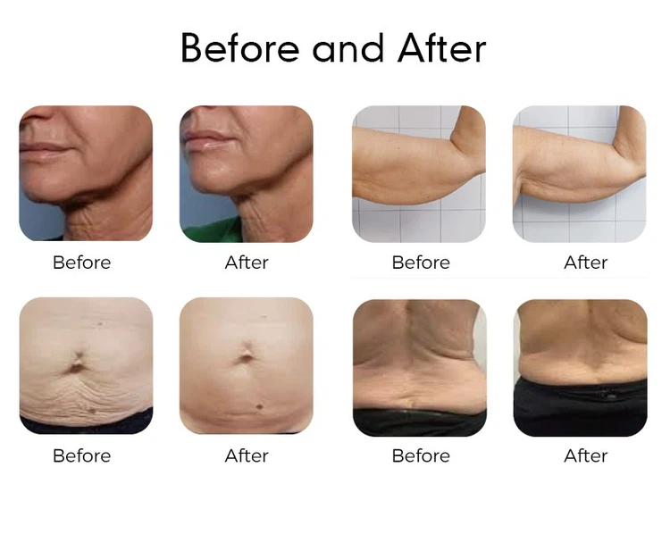 microwave body contouring machine microwave body contouring machine